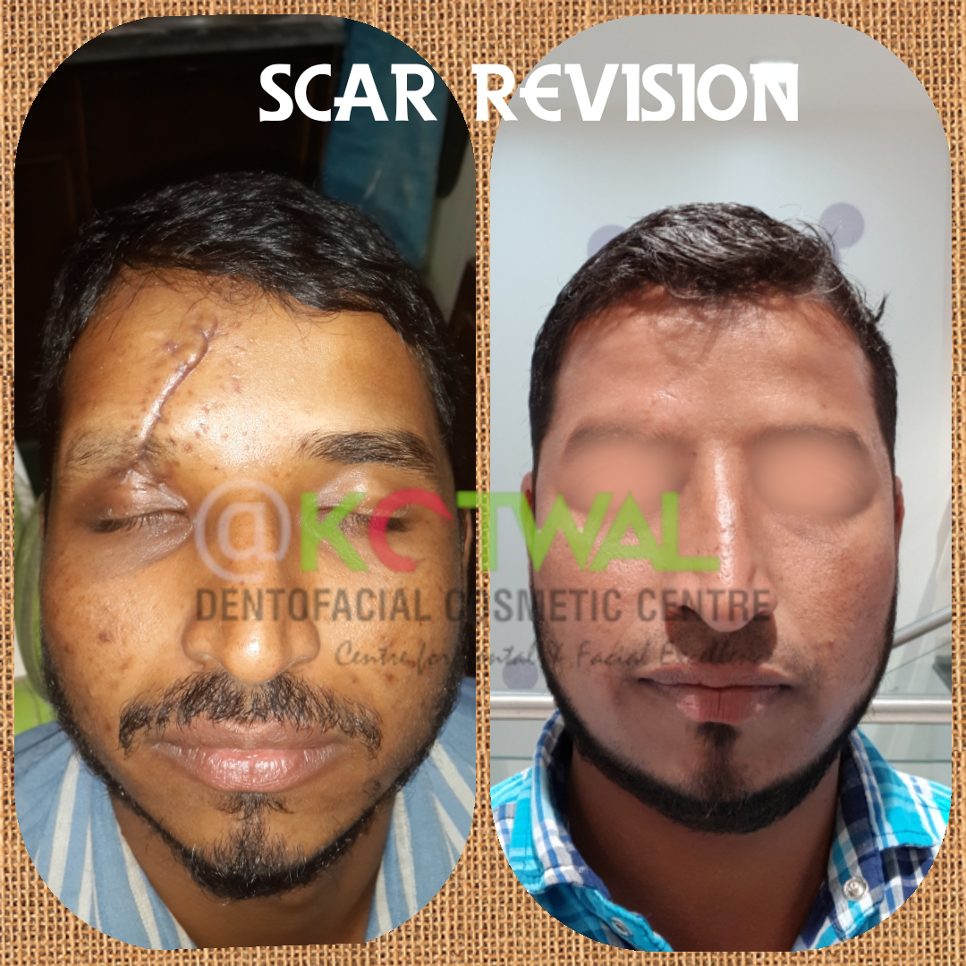 Scar Revision